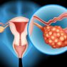 When Endometriosis Becomes Malignant