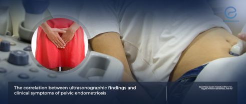 Ultrasonographic findings and the clinical symptoms of pelvic endometriosis