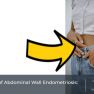 A pictorial overview of abdominal wall endometriosis  