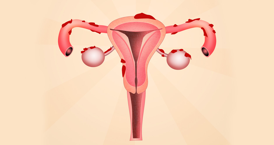 Endometriosis Micrometastasis