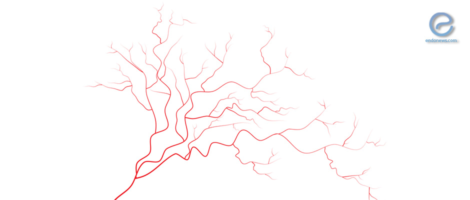 Reduced vascularization in ovarian endometriomas associated with less pain