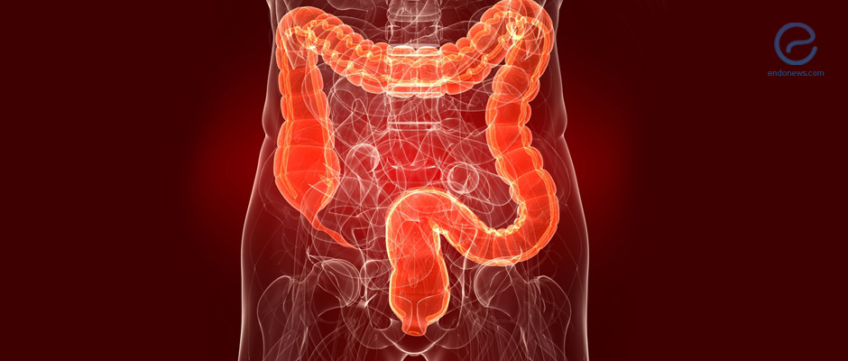 Bowel Involvement in Deep Infiltrating Endometriosis