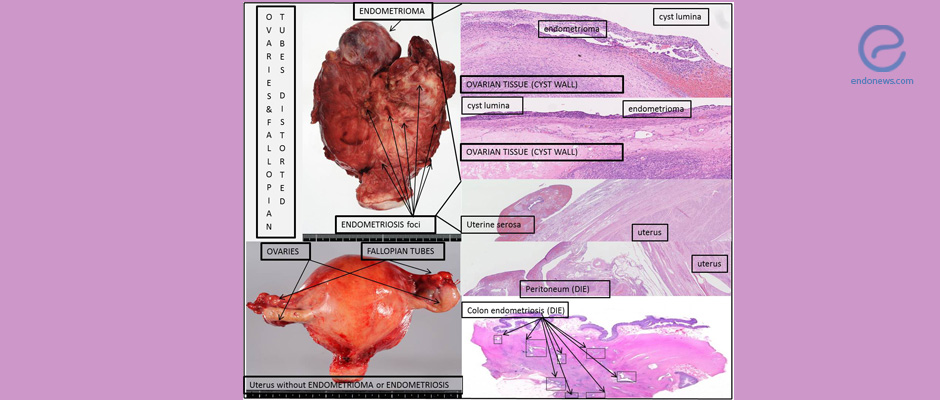 Ovarian Endometriomas vs Deep Infiltrating Endometriosis