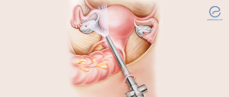 Cohort study on outcomes of laparoscopic endometriosis surgery