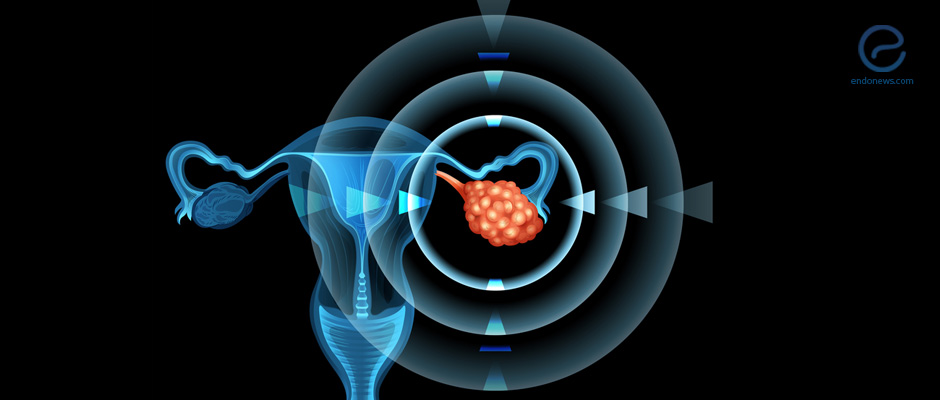 A new hypothesis for the origin of endometriosis-associated ovarian cancers