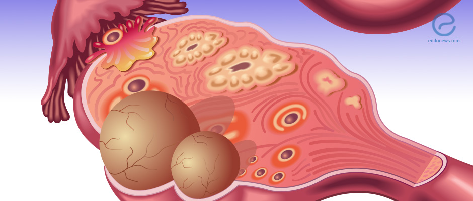 Benign Gynecological Tumors in Women with Endometriosis