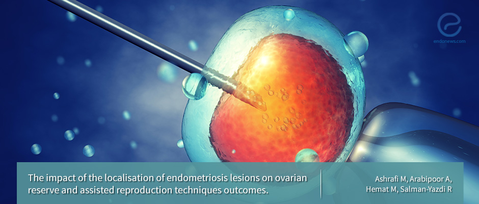 How Ovarian Endometriomas and DIE affect ART outcomes
