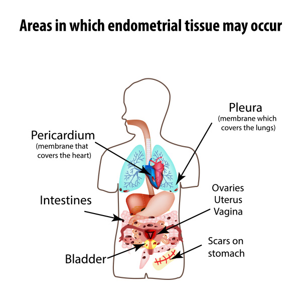 Aresy in which Endometrial Tissue may occur
