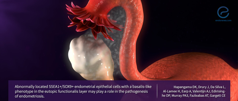 Is the mystery for  progression of endometriosis hiding out in abnormally located endometrial cells?