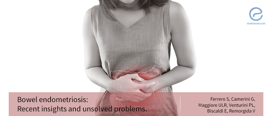Bowel endometriosis: What you need to know