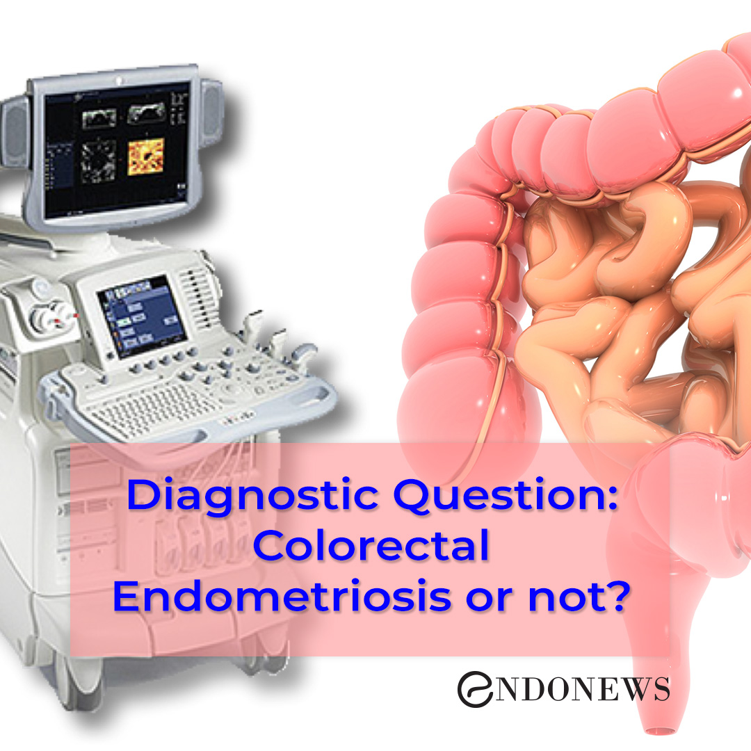 The accuracy of "lower endoscopic ultrasound" for the preoperative