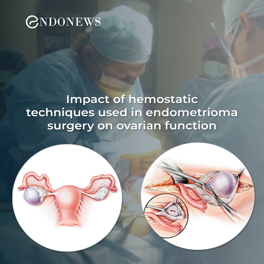 Impact of hemostatic techniques used in endometrioma surgery on ovarian