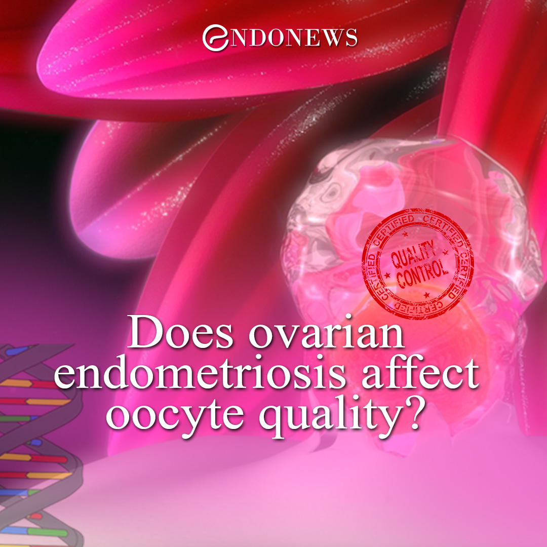Does ovarian endometriosis affect oocyte quality? EndoNews