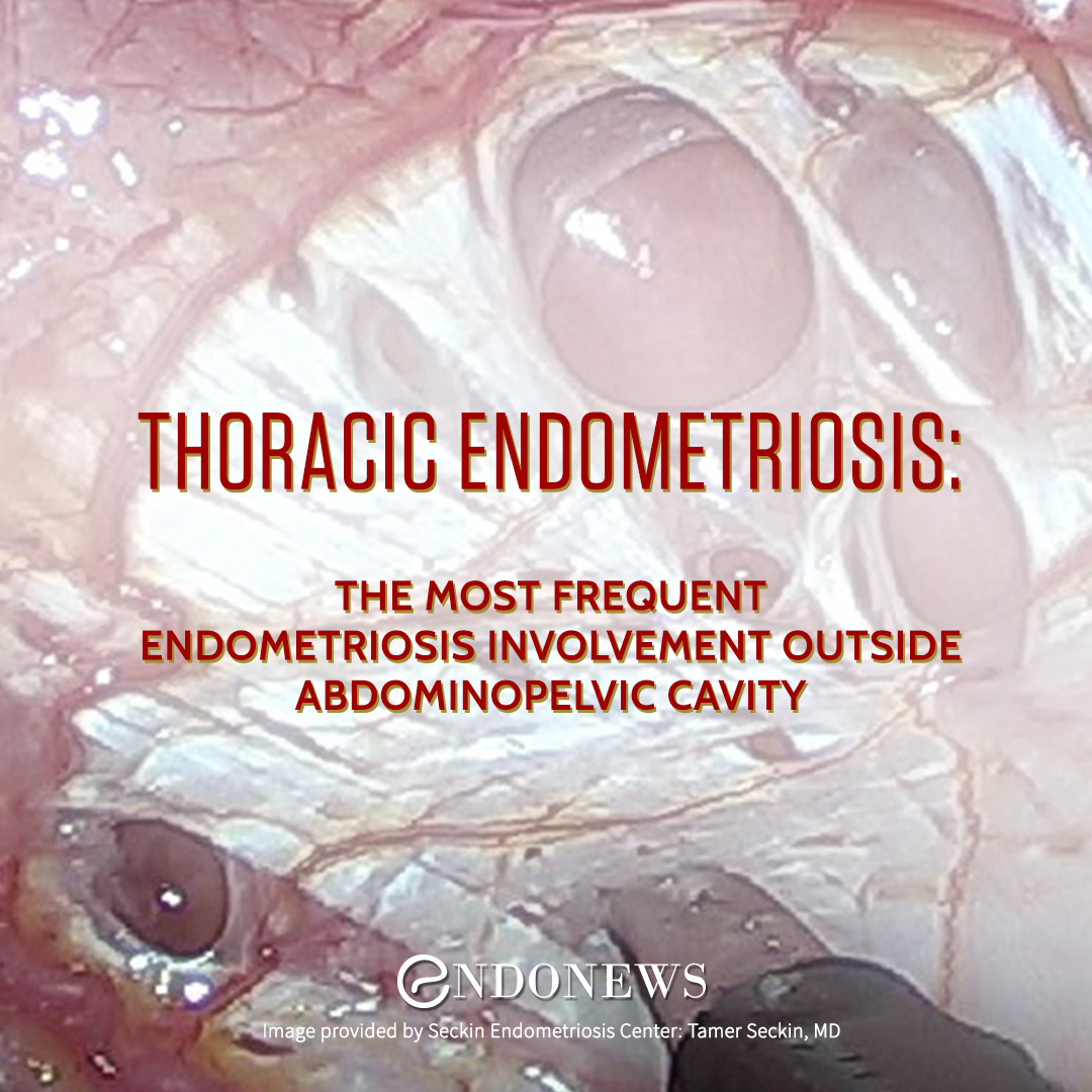 Thoracic endometriosis the most frequent endometriosis involvement outside abdominopelvic