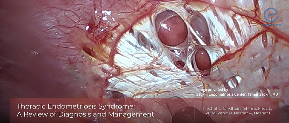 Thoracic endometriosis: the most frequent endometriosis involvement outside abdominopelvic cavity