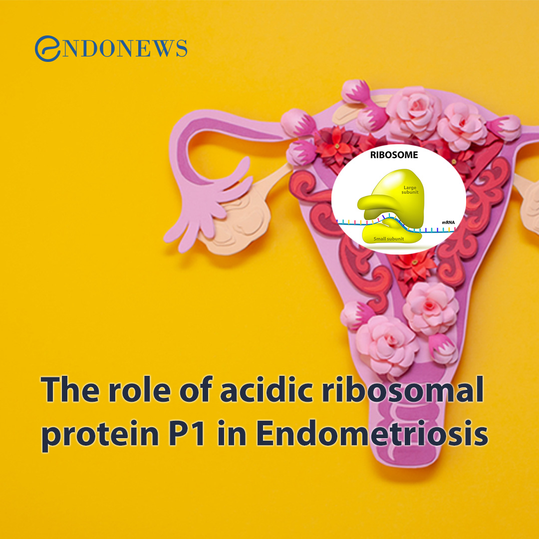 The role of acidic ribosomal protein P1 in Endometriosis EndoNews