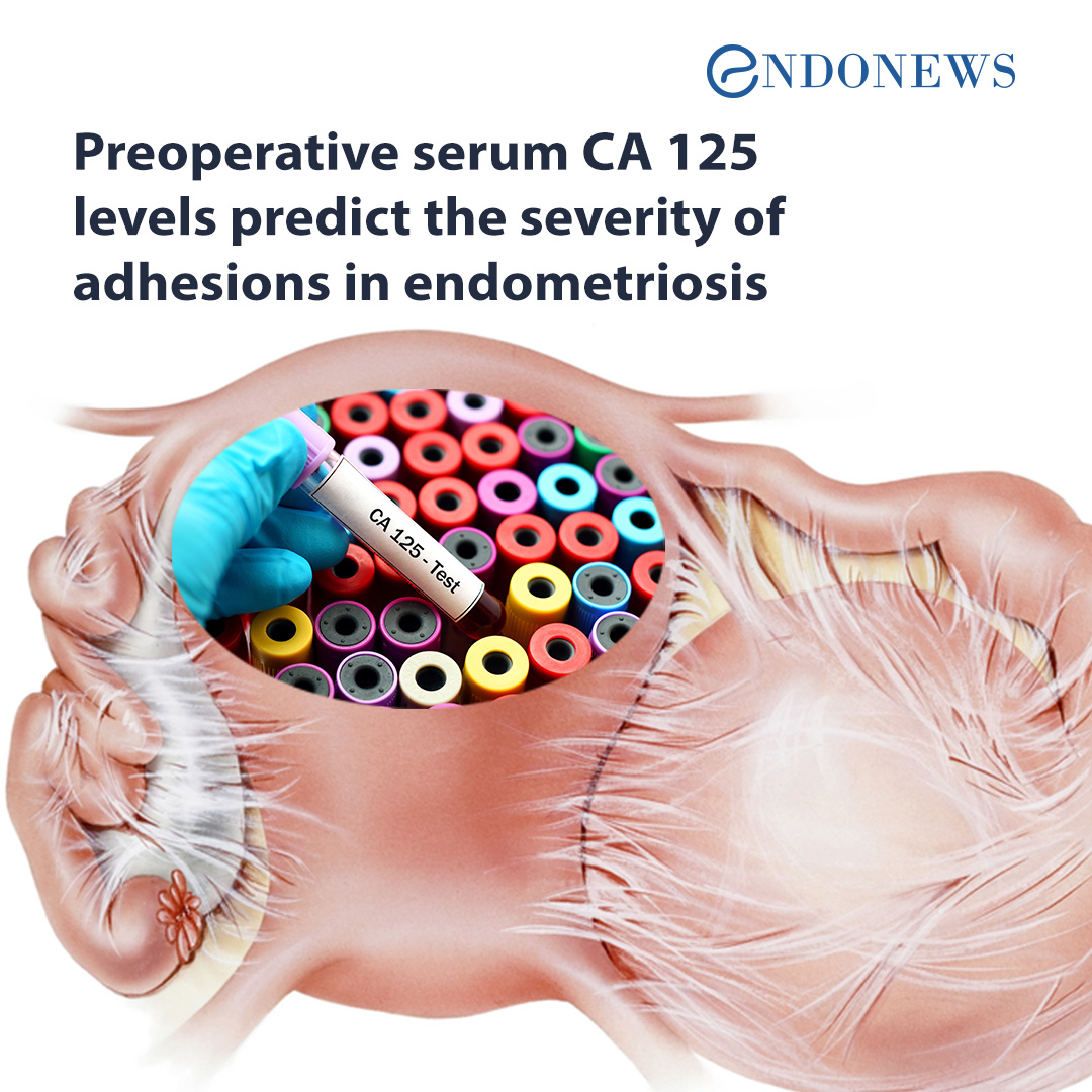 Preoperative serum CA 125 levels predict the severity of