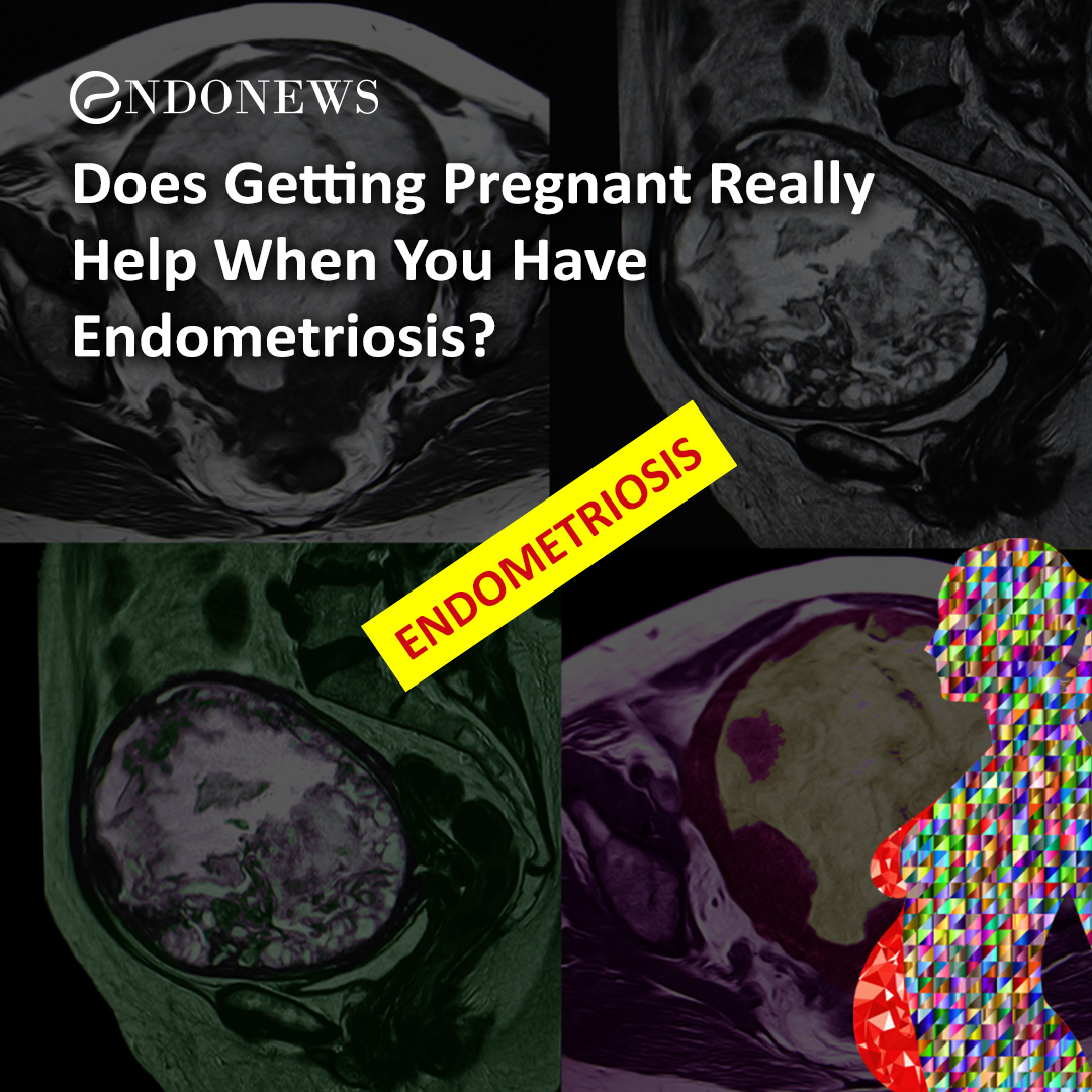 Does Getting Pregnant Really Help When You Have Endometriosis? EndoNews