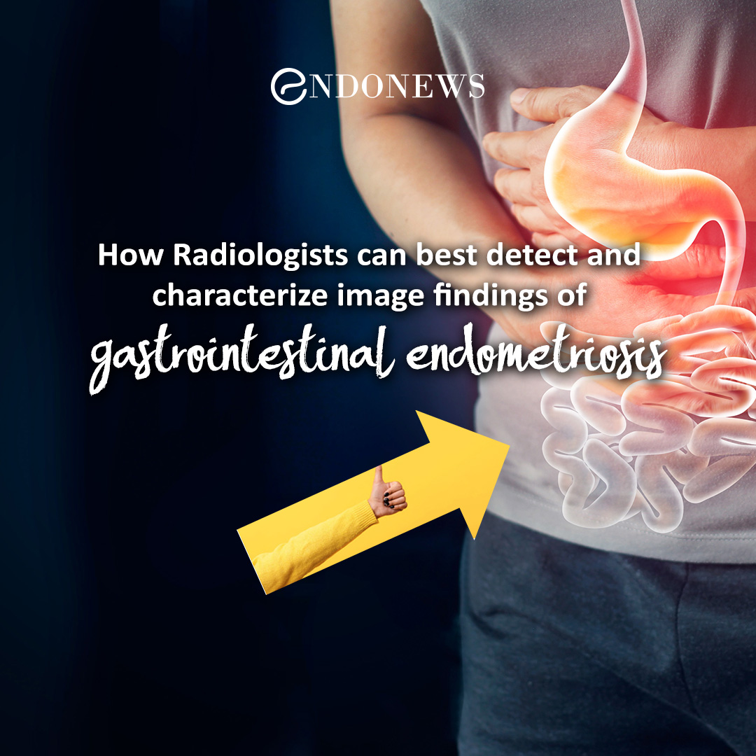 Imaging of gastrointestinal endometriosis EndoNews