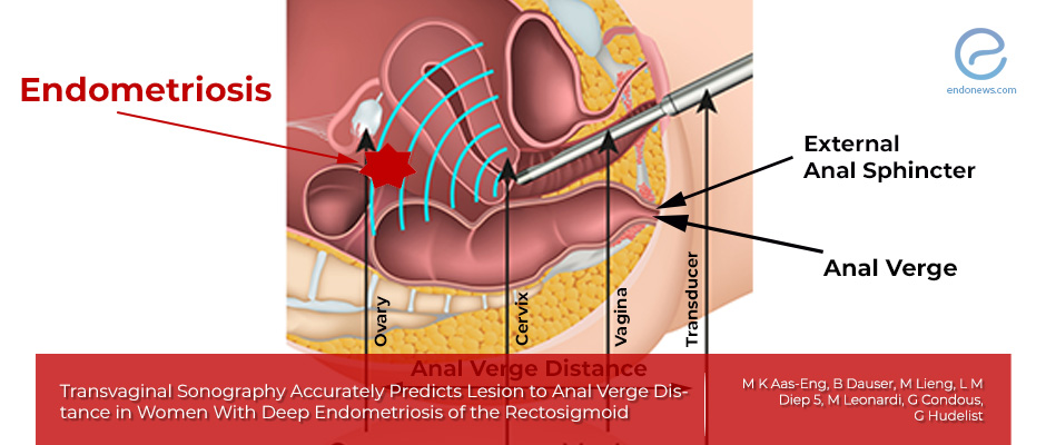 Transvaginal sonography for predicting the distance between rectosigmoid endometriosis and the anal verge