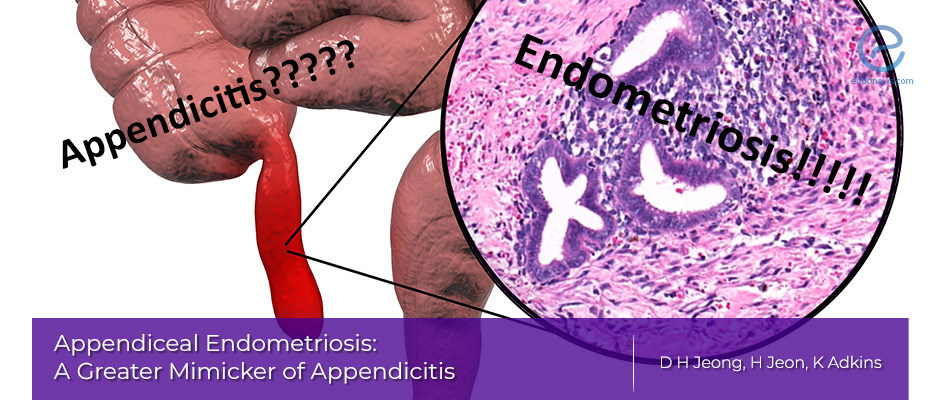 Appendiceal endometriosis