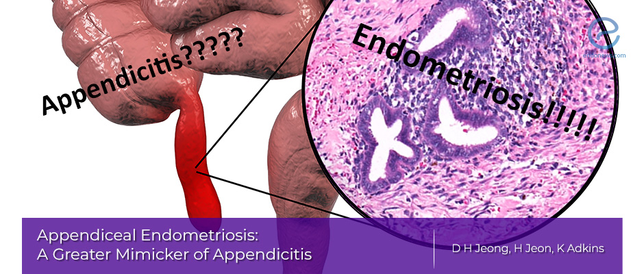 Appendiceal endometriosis