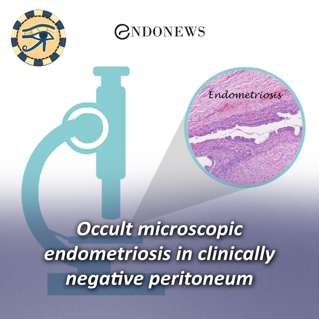 Occult microscopic endometriosis in clinically negative peritoneum