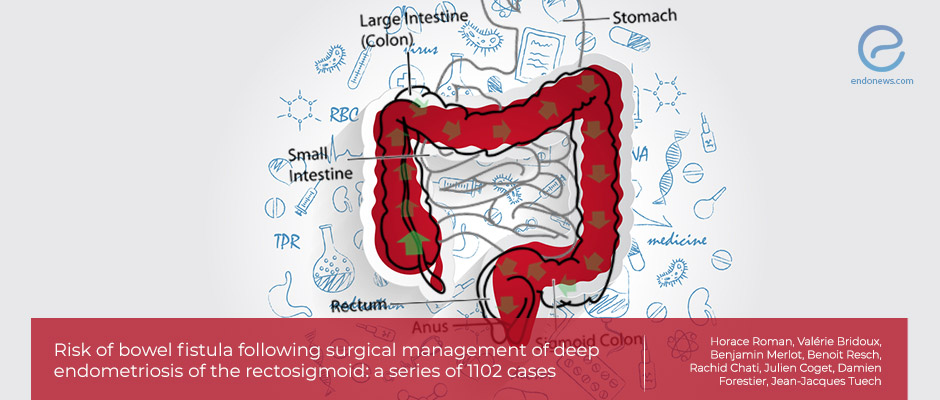 Prevalence, Risk factors and Management of Bowel Fistula after Rectosigmoid Surgery for Deep Endometriosis