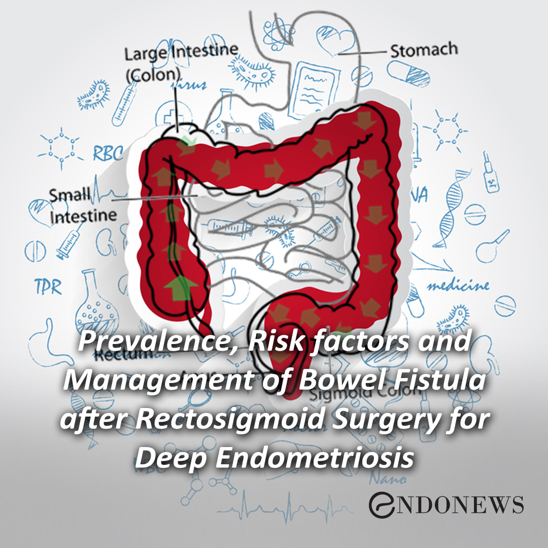 Prevalence, Risk factors and Management of Bowel Fistula after