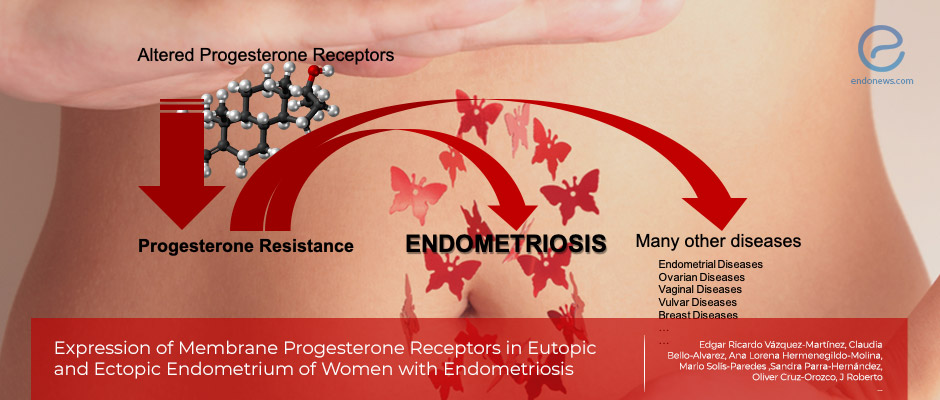 Progesterone Receptors and Endometriosis.