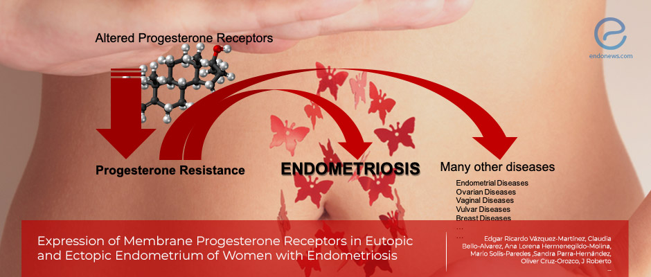 Progesterone Receptors and Endometriosis.