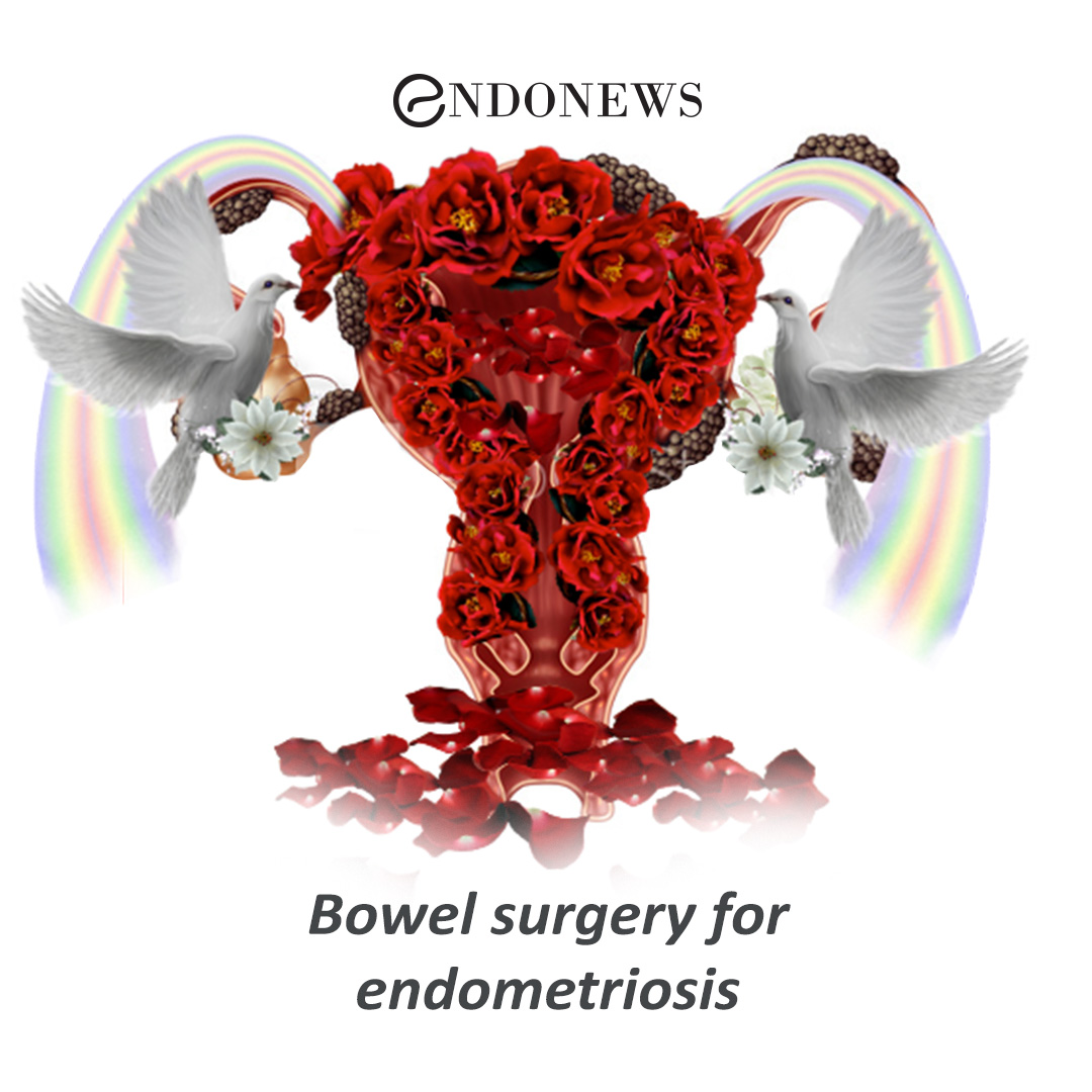 Bowel surgery for endometriosis EndoNews