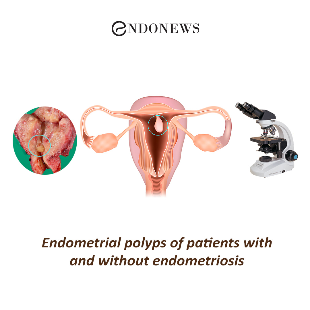 endometrial-polyps-of-patients-with-and-without-endometriosis-endonews