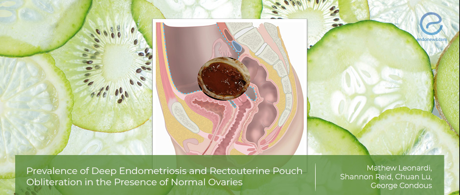 Deep Endometriosis or Recto-uterine Obliteration Without Endometrioma