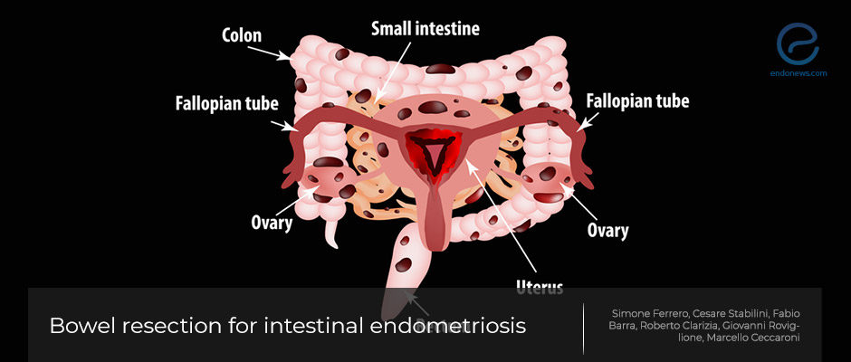 Time for reassessment: Laparoscopic surgery and bowel endometriosis