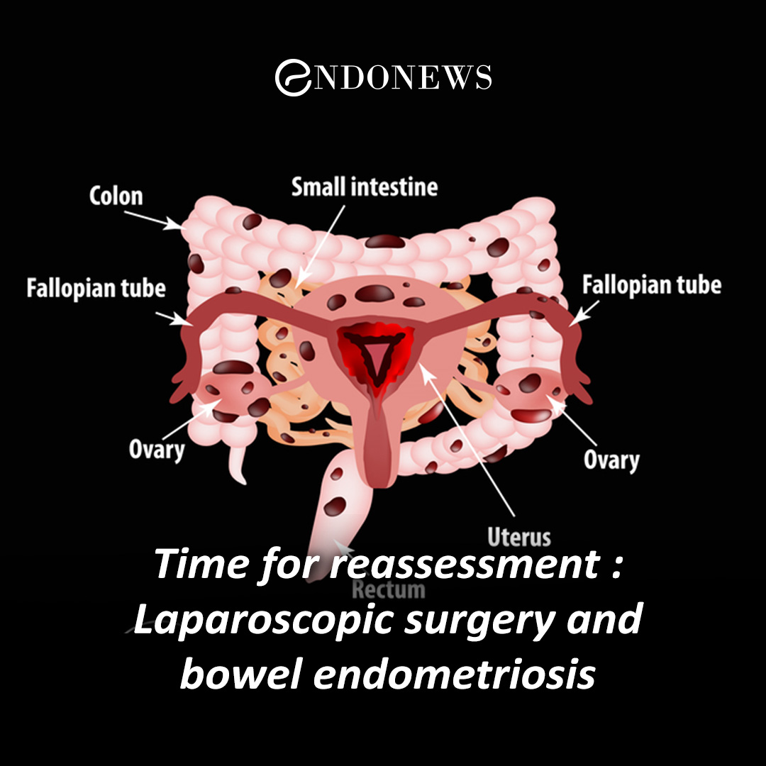 Laparoscopic Excision of Endometriosis