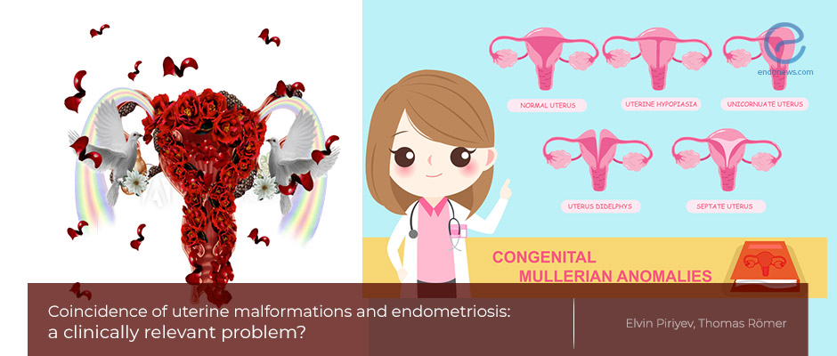 The more than expected prevalence of endometriosis in patients with Mullerian abnormalities 