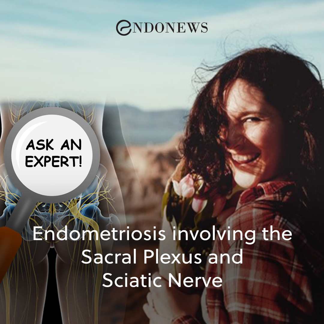 Endometriosis involving the Sacral Plexus and Sciatic Nerve EndoNews