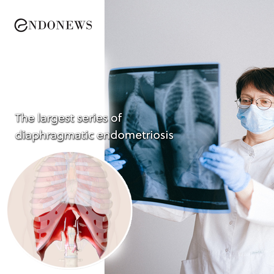 The largest series of diaphragmatic endometriosis EndoNews