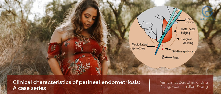 Perineal Endometriosis, How Soon Does it Return After Surgery?