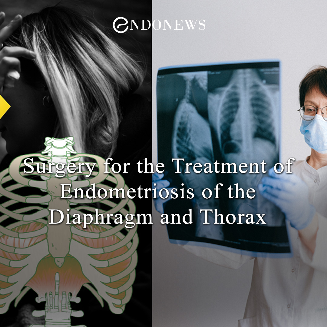 Surgery for the Treatment of Endometriosis of the Diaphragm and Thorax EndoNews