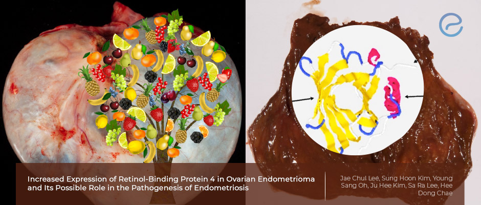 Retinol-binding protein in endometriosis  pathogenesis
