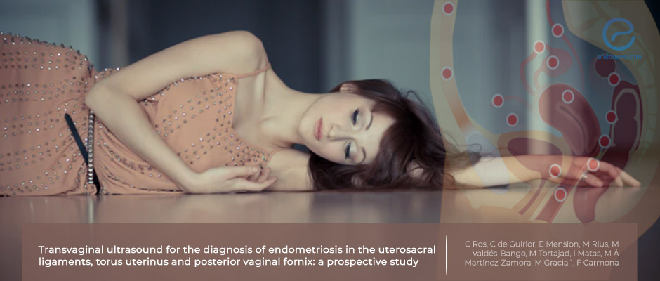 Transvaginal Ultrasound Accuracy for Uterosacral Ligament, Torus Uterinus and Posterior Fornix Endometriosis