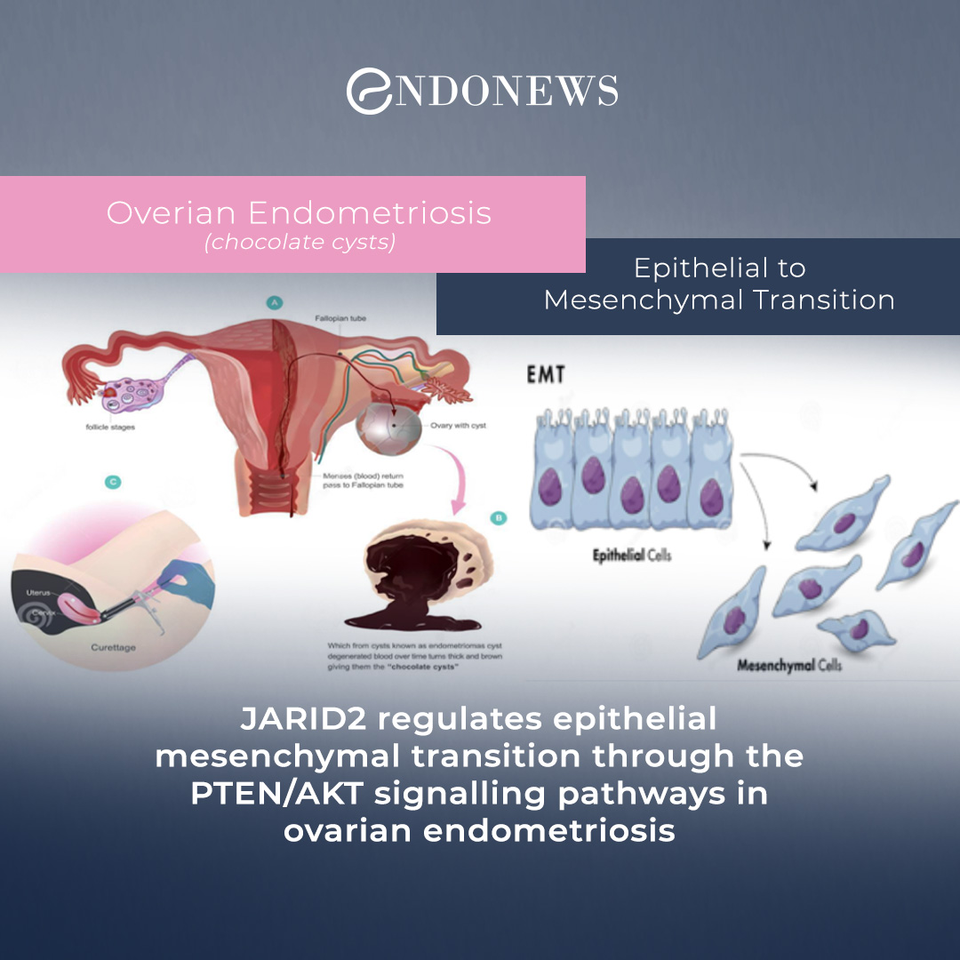 Molecular Alterations in Ovarian Endometriosis EndoNews
