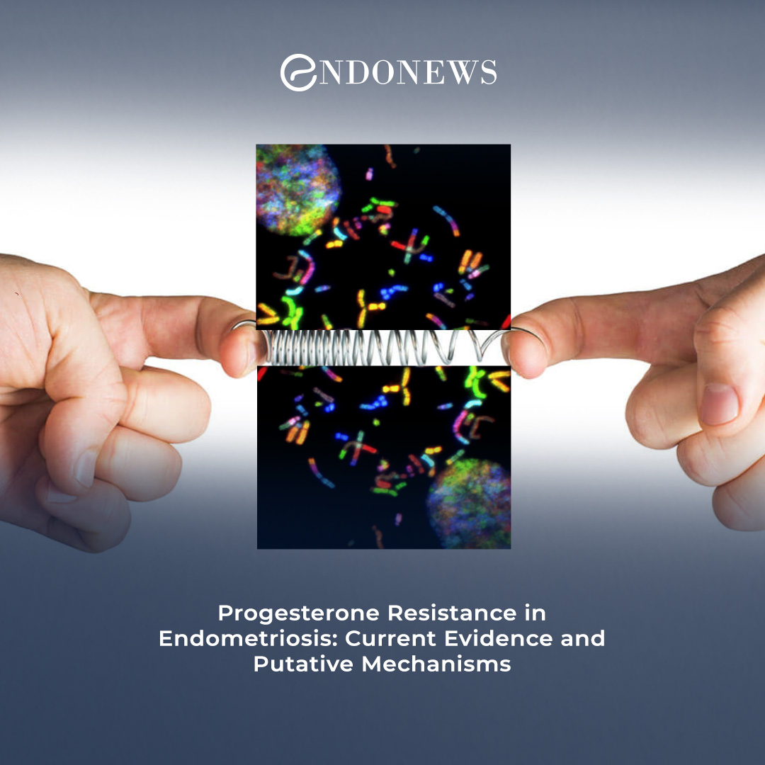 Endometriosis and Progesterone Resistance EndoNews