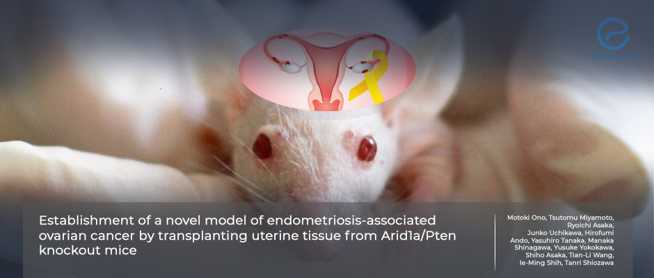 New Model Can Help Understand How Endometriosis-Associated Ovarian Cancer Develops