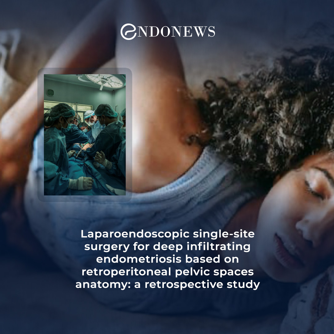 "Transumblical singleport laparoscopy" for deep infiltrating endometriosis. EndoNews