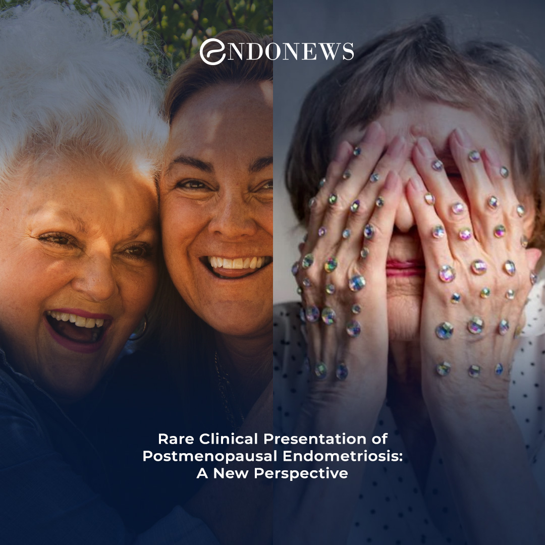 Diagnosis and the Treatment of Postmenopausal Endometriosis EndoNews