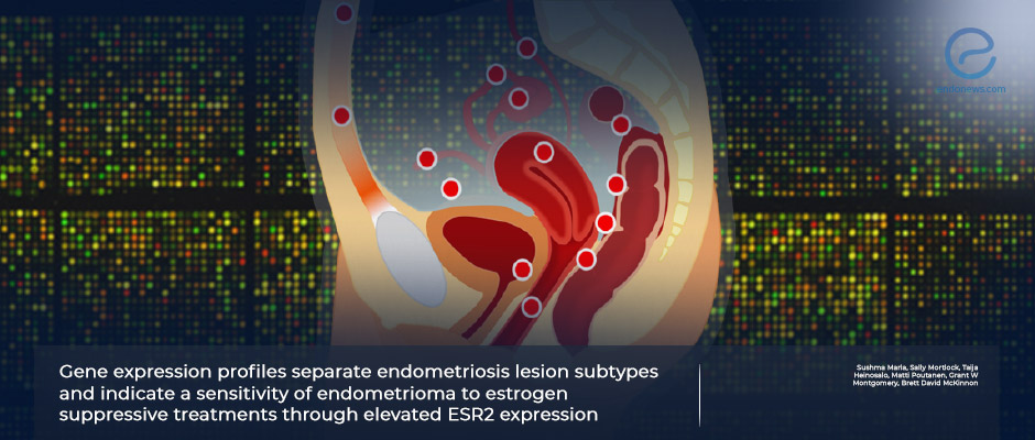 Gene Expression Profiles of  Endometriosis and Personalized Treatment