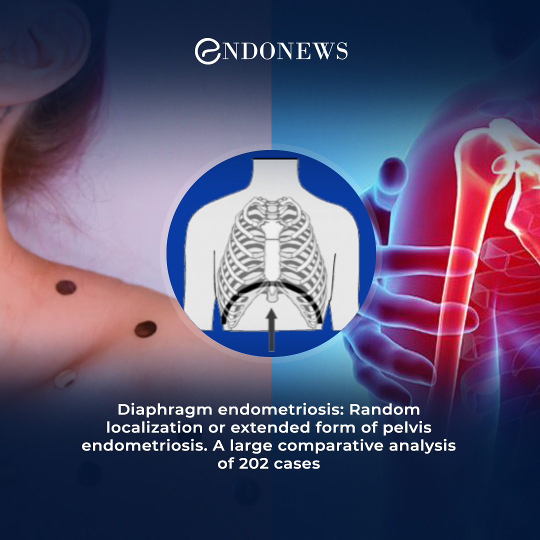 New visions on diaphragmatic endometriosis EndoNews